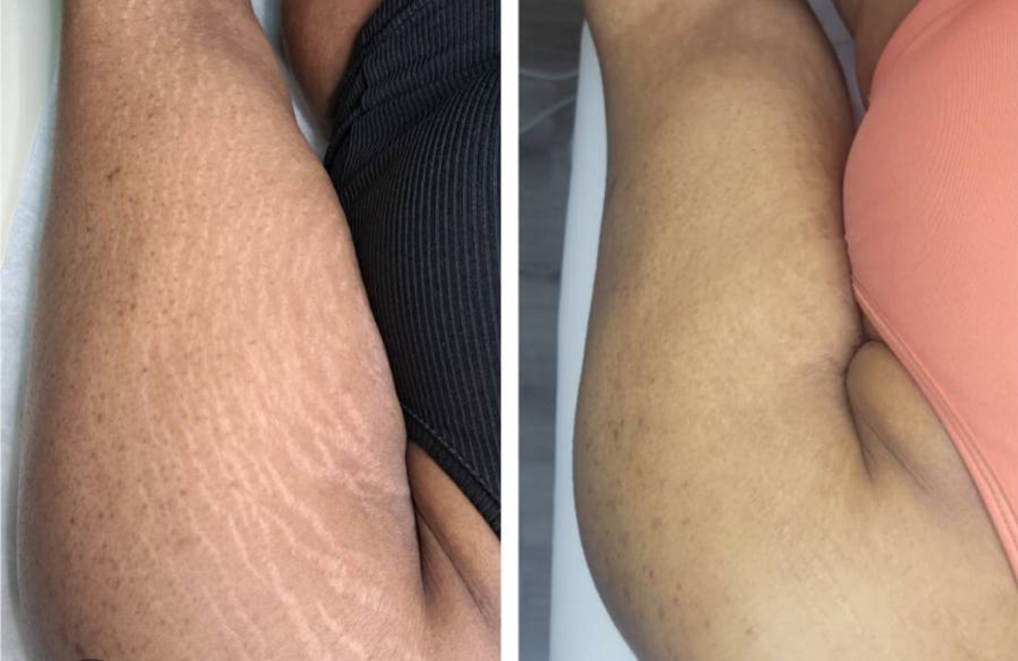 Before and after treatment 3