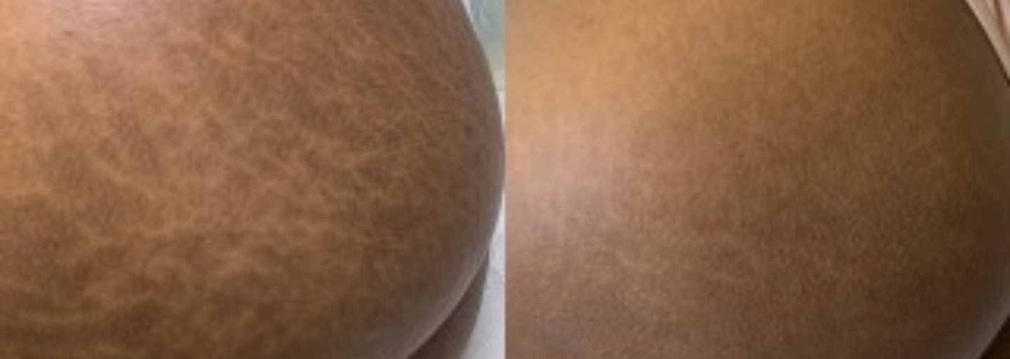 Before and after treatment 2